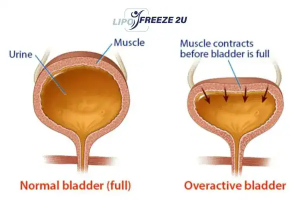 diagram of overactive bladder treatment Hammersmith