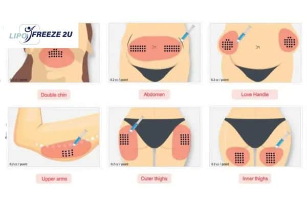 Benefits of Choosing Aqualyx for Fat Reduction Hammersmith