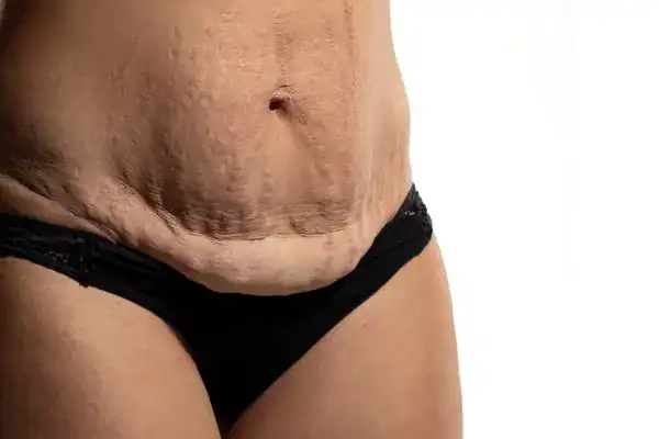 loose skin after weight loss injections Hammersmith