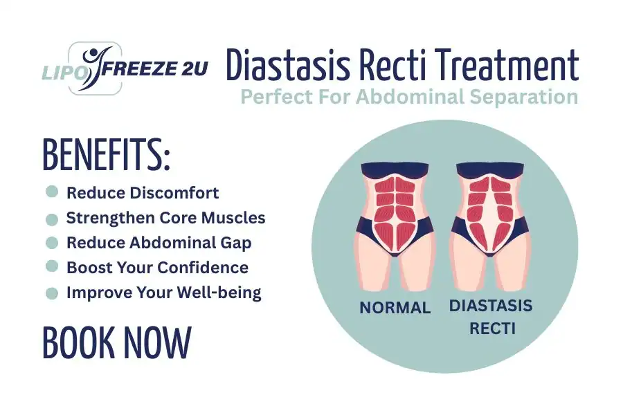 Benefits of body toning treatment Hammersmith for Diastasis recti