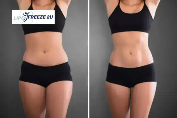 How Can LIPO FREEZE 2U Support Your Post-Pregnancy Body Recovery Hammersmith?