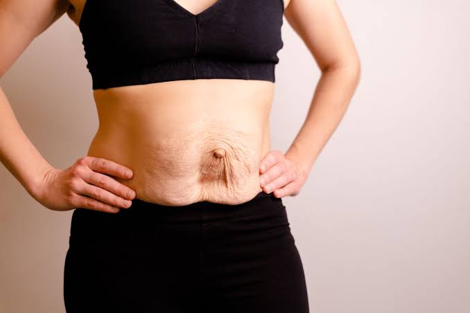 Is Surgery Really the Only Way to Repair Diastasis Recti Hammersmith?
