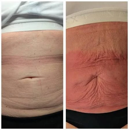 How Does RF Microneedling Improve Crepey, Thin and Uneven Skin Texture Hammersmith?