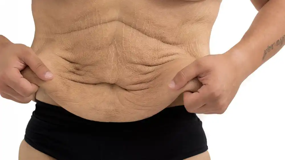 Why Does Weight Loss Medication Leave Some People With Loose or Sagging Skin Hammersmith?